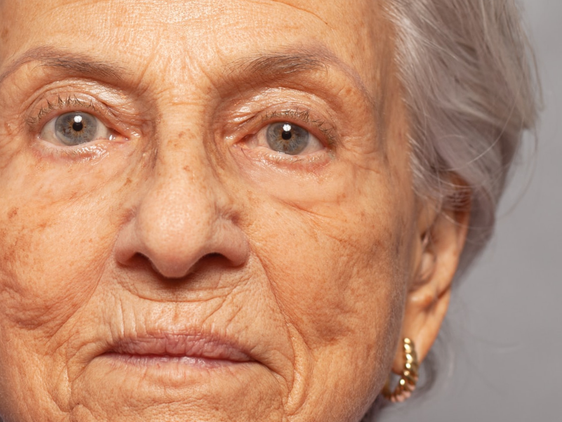 Типы морщин на лице: мимические, старческие, атрофические и гравитационные