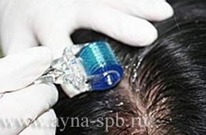 мезороллер для лечения волос