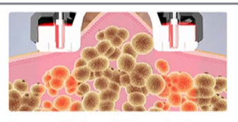 Вакуумный RF-лифтинг: липолиз, лимфодренаж, укрепление кожи и повышение эластичности тканей